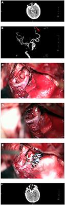 Endovascular intervention vs. microsurgery on the prognosis of anterior circulation blood blister-like aneurysm: A cohort study